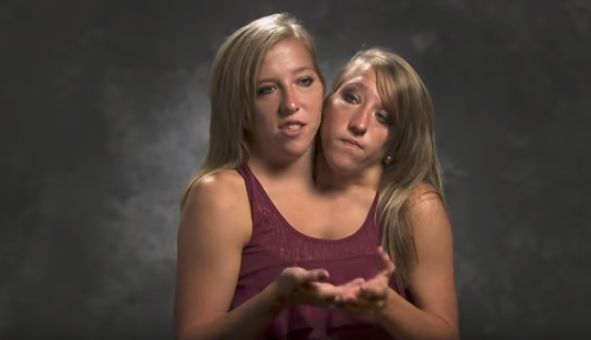 How Conjoined Twins Abby And Brittany Hensel Look Like